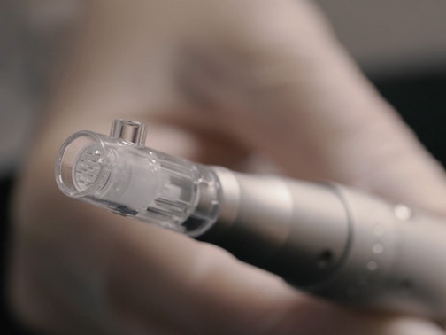 Microneedling Microneedling